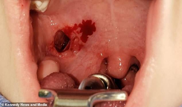 Criança de 5 anos tem garganta furada após cair com escova de dente na boca