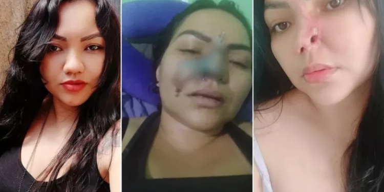 Mulher perde parte do nariz e tem outras sequelas após cirurgia estética com dentista