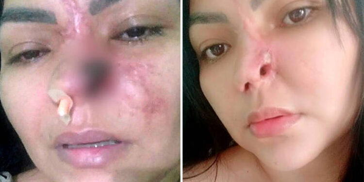Dentista é indiciado após paciente perder parte do nariz