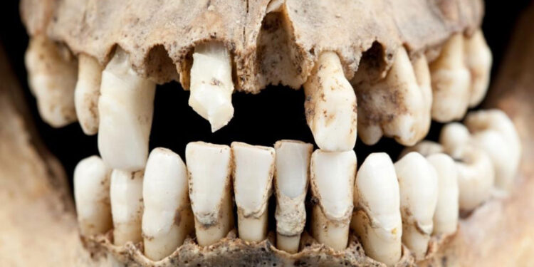 Bactérias dentária de neandertais são usados em antibióticos