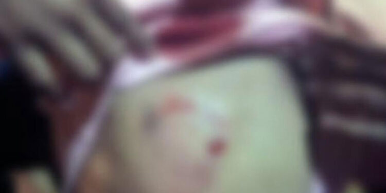 Criança fica gravemente ferida após ataque de pitbull no RJ