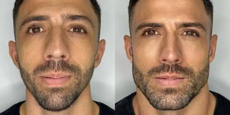 Antes e depois de masculinização facial choca web e viraliza: ‘mudou até o DNA’