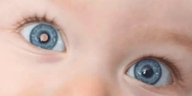 A Importância da Saúde Ocular Infantil: Fique Atento ao Retinoblastoma