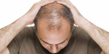 Proteína é nova esperança para o fim da calvície